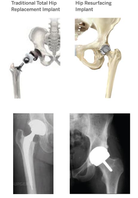 Understanding Implants In Knee And Hip Replacement