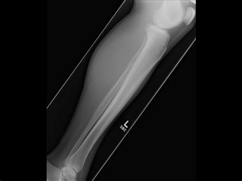 Ortho Dx A Fibula Fracture With Ankle Swelling Clinical Advisor