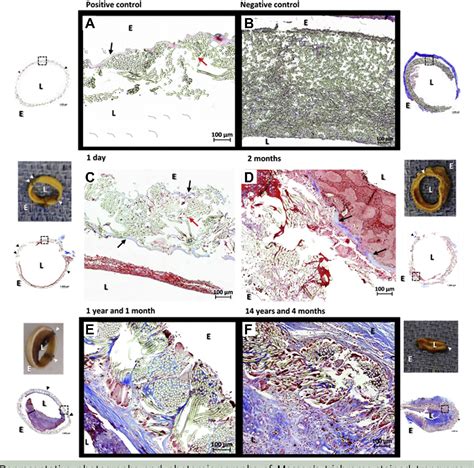 Figure From Vascular Grafts Collagen Coating Resorption And Healing