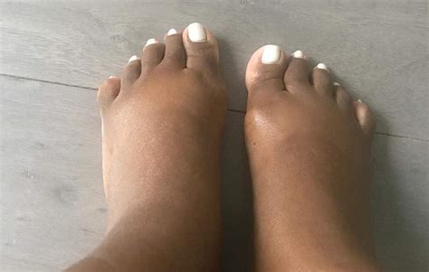 Swollen Feet During Pregnancy Medical Education