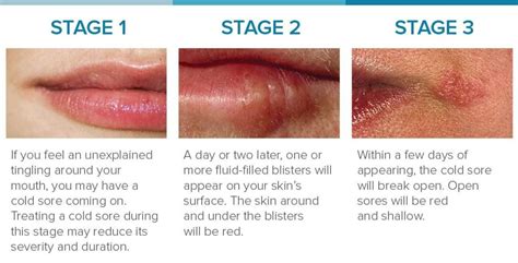 Or maybe you just aren't convinced that the bump on the edge of your s.o.'s mouth is really a pimple? Cold Sore Stages: Identification and Treatment
