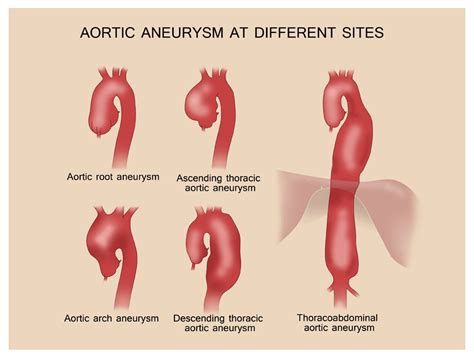 Aortic Aneurysm Aortic Dissection Nuhcs National Univ