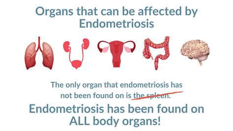 What Is Endometriosis Eighty Six The Endo