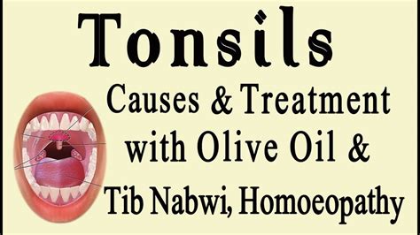 Tonsils Treatment Of Tonsils Causes Of Tonsils By Drasghar