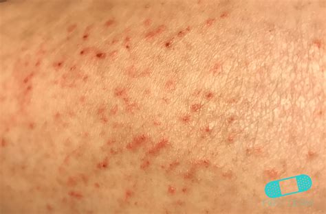 Skin Rashes Images Galleries With A Bite