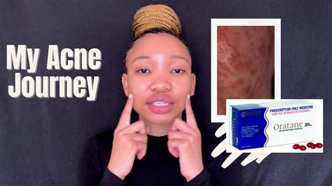 Is Oratane Accutane The Cure To Acne The Side Effects And My Acne Journey YouTube