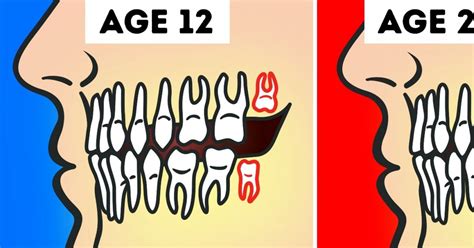 An impacted wisdom tooth may partially emerge so that some of the crown is visible (partially impacted), or it may never break through the gums (fully impacted). Do We Really Need to Remove Wisdom Teeth?