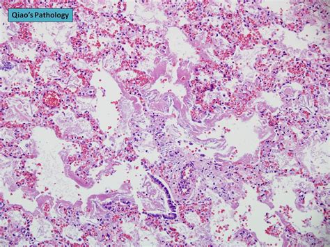 Qiao S Pathology Hyaline Membrane Disease Infant Respira Flickr