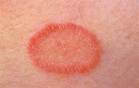 How To Get Rid Of Pityriasis Rosea Naturally With Home Remedies