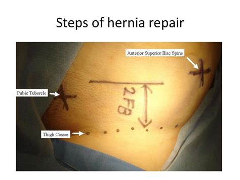 Surgical Anatomy Of Inguinal Hernia