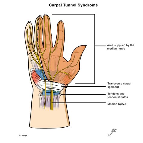 Carpal Tunnel Syndrome Msk Medbullets Step 1