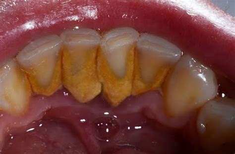 Orange Plaque On Teeth And How To Control It Dental Pickup