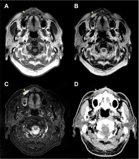 Pre Operative Mri And Cect A C Axial Views On Mri A T1 Weighted