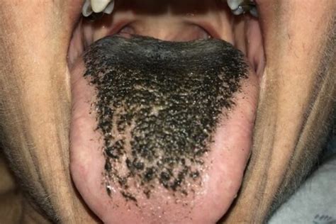 Pimples On Tongue Under On Tip Side Or Back And Getting Rid Of