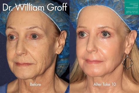 What Is The Best Treatment For Deep Facial Wrinkles Cosmetic Laser Dermatology Skin