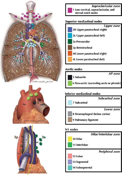Figure 1 From Revised Ests Guidelines For Preoperative Mediastinal