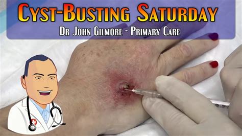 Best Cysts And Pops On Youtube All Star Doctors By Dr Gilmore 👍💯😬😍