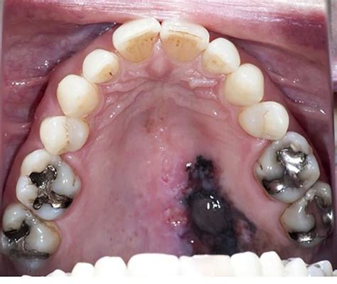 Oral Cancer Wong 2018 Australian Dental Journal Wiley Online