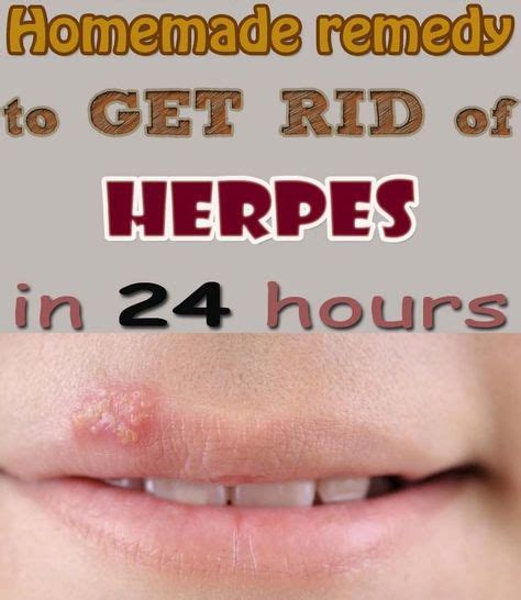 homemade remedy to get rid of herpes in 24 hours home remedies for herpes herpes treatment