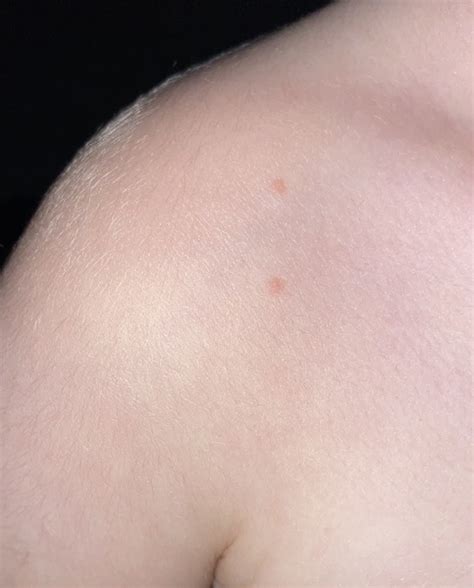 What Are These Spots On My Child Mumsnet