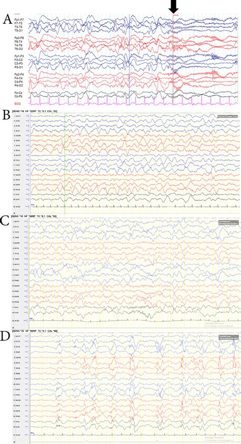 The Evolution Of Electroencephalography Eeg Of The Patient A Initial