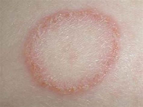 White Rash On Skin Images And Photos Finder
