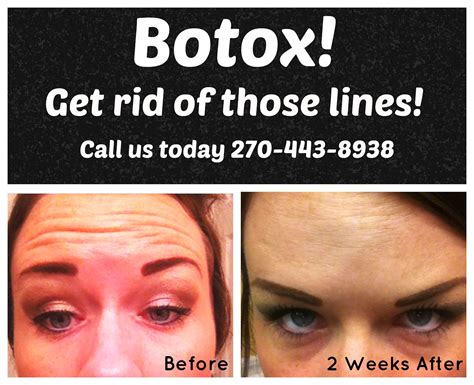 Botox Before And After Botox Botox Before And After Botox Cosmetic