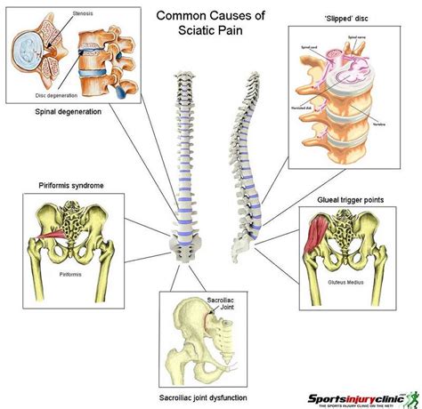 But because those nerve roots course through the sciatic nerve, the pain is also felt down the buttock and thigh. Sciatica (Lumbar Radiculopathy) | Wake Spine & Pain
