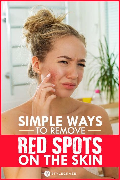 6 Natural Ways To Treat Red Spots On Skin And Prevention Tips Red