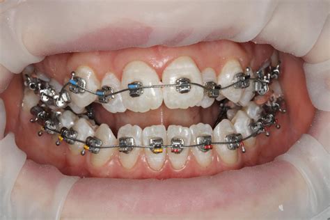 Orthodontics Braces Patient