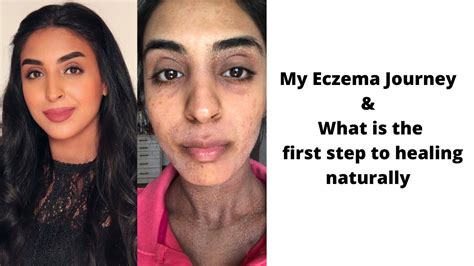 My Eczema Journey Andthe First Step To Healing Youtube