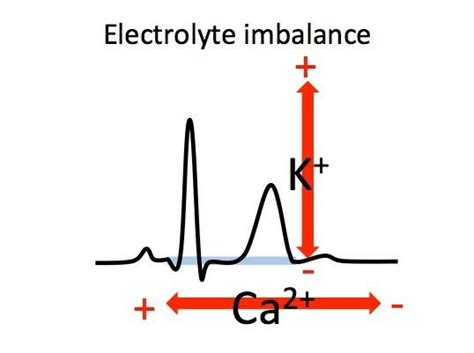 Electrolyte Imbalances Ekg Emergency Nursing Medical School Studying