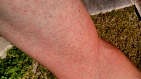 Rash On Legs Causes Symptoms Itchy Remedies And Treatment American
