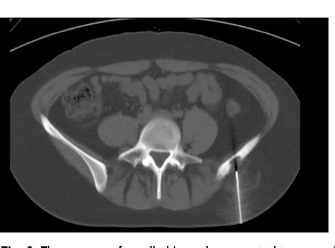 Figure 3 From Diagnosis Of Solitary Eosinophilic Granuloma By Ct Mri