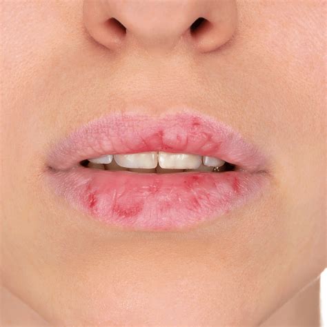 What Causes Dry Chapped Lips Stop Doing This Now