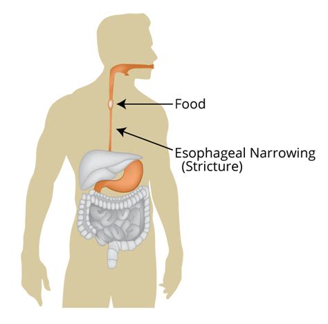 Dysphagia Or Airway Blockage What Is The Difference And Treatment