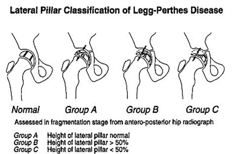 Legg Calve Perthes Disease Core Em
