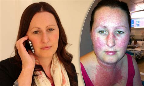Iphone Cover Causes Allergic Reaction Covering Womans Face And Neck In