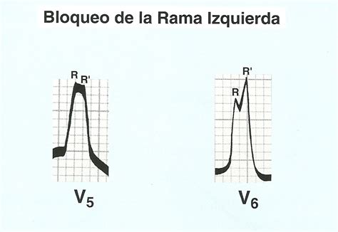 Electrocardiograma Bloqueos De Rama
