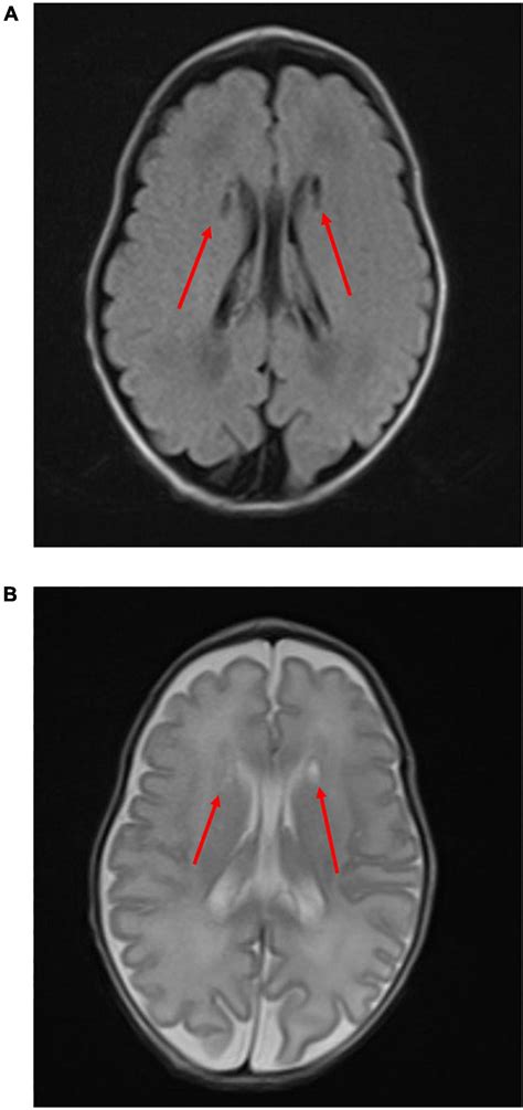 Frontiers Case Report A Very Low Birth Weight Female Infant With