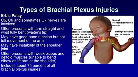 Normal Anatomy Of Brachial Plexus And Location Of Pal