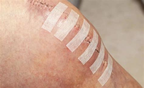 Suturer une plaie méthodes et délai de retrait des points de suture