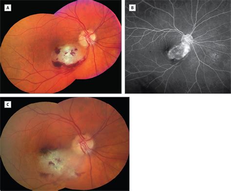 Management Of Retinal Whitening With Vitritis Infectious Diseases