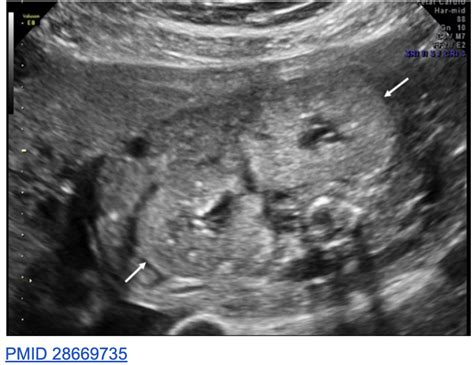 Hello Nephtwitter Renal Medtwitter Aspneph Radiology Webinar For August Was Autosomal