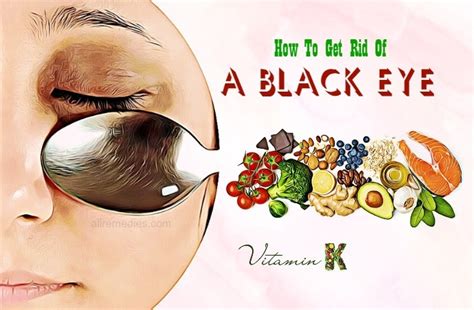 16 natural remedies how to get rid of a black eye and swelling fast