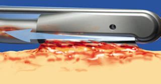 Depending on the type and seriousness of the wound, doctors. VERSAJET II Hydrosurgery System | Smith & Nephew - US ...