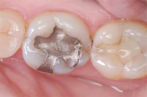 Safe Silver Filling Removal Remove Toxic Amalgam