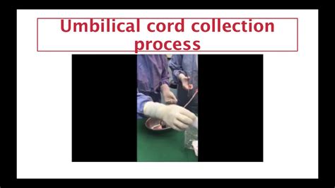 Umbilical Cord Collection For Stem Cell Culture Youtube