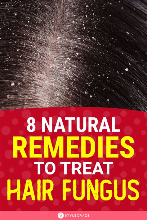 How To Get Rid Of Fungal Scalp Infection 8 Natural Remedies In 2020