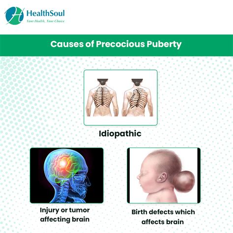 Precocious Puberty Causes Diagnosis Treatment Healthsoul